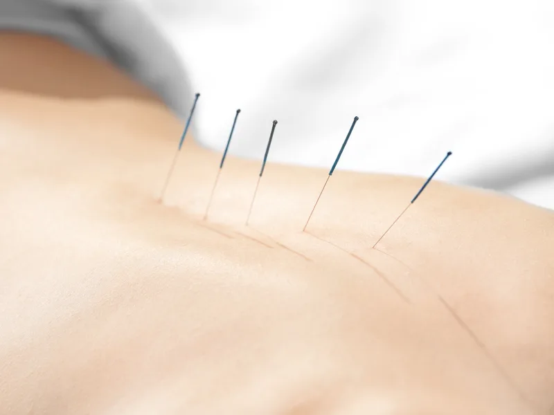 Acupuncture at Wellness Revolution in Evanston