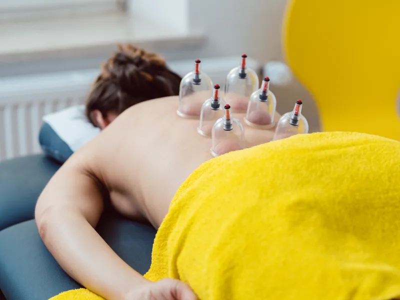 Cupping Therapy at Wellness Revolution in Evanston