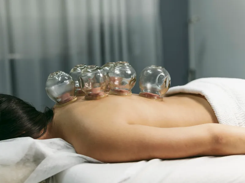Cupping Therapy at Wellness Revolution in Evanston