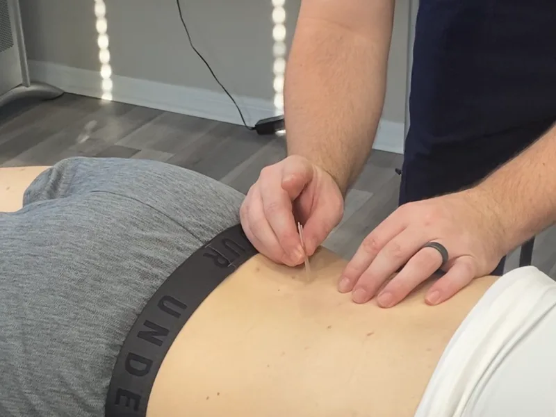 How Dry Needling works at Wellness Revolution