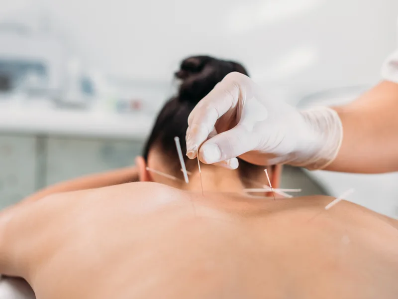 Dry Needling at Wellness Revolution in Evanston